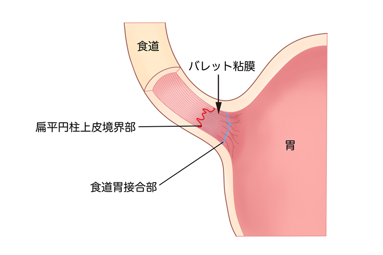 バレット食道とは