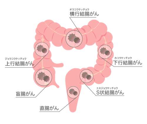 大腸がんとは