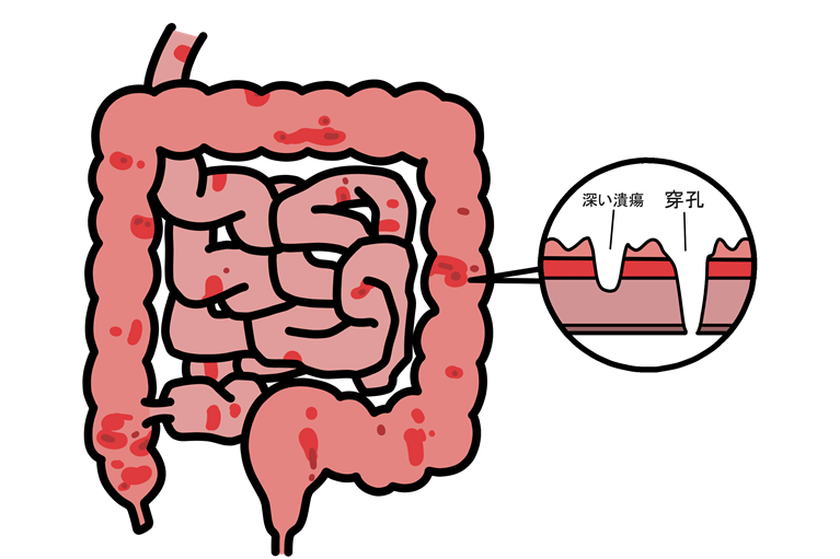 クローン病とは