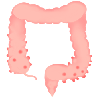 大腸憩室症とは