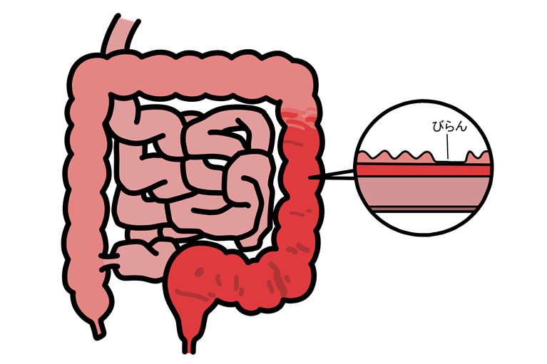 潰瘍性大腸炎とは